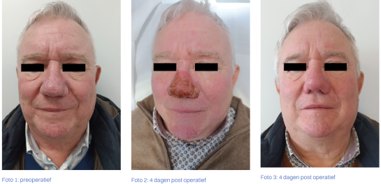 Rhinophyma stadia behandeling