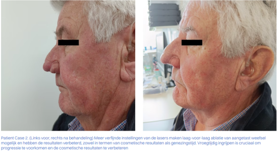 Rhinophyma behandeling